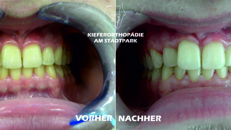 Bleaching – Zahnaufhellung der natürlichen Zähne